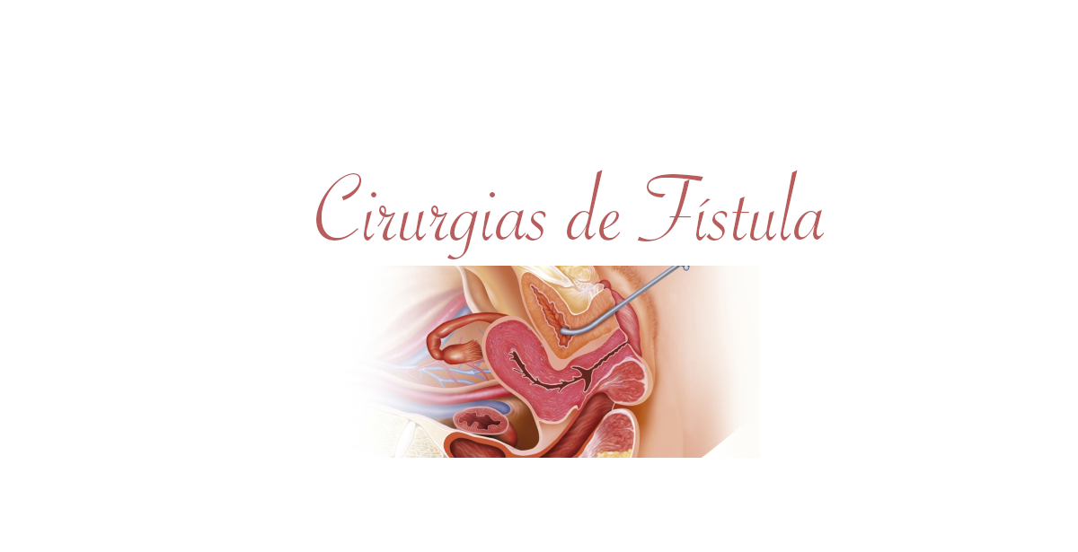 Cirurgias de Fístula